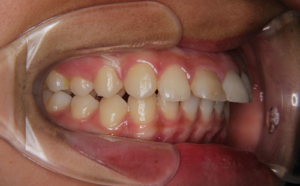 上の前歯の出っ張りと下の前歯の隙間が気になる